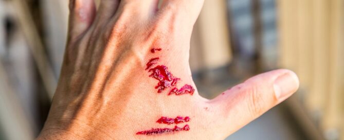 Proving Negligence After a Dog Bite Injury in California